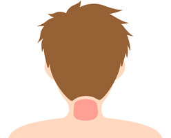 脱毛部位の図　-うなじ-